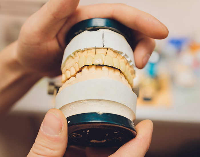 立川の歯医者、まろ歯科クリニックの詰め物・被せ物が取れた場合の治療