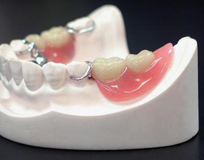 立川の歯医者、まろ歯科クリニックのインプラント治療