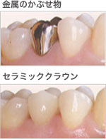 立川の歯医者、まろ歯科クリニックのノンメタル治療