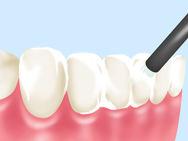 立川の歯医者、まろ歯科クリニックの予防歯科