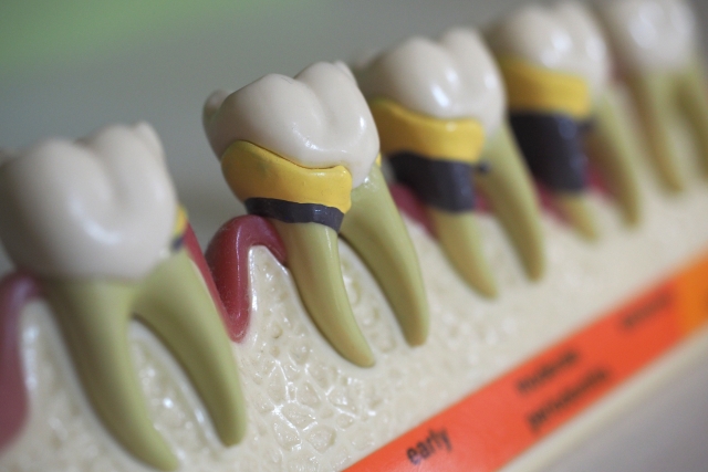 立川の歯医者、まろ歯科クリニックの歯周病治療