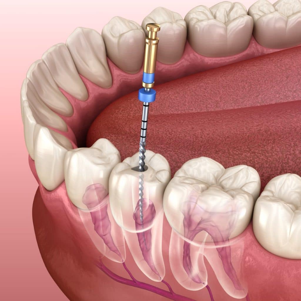 立川の歯医者、まろ歯科クリニックの根管治療