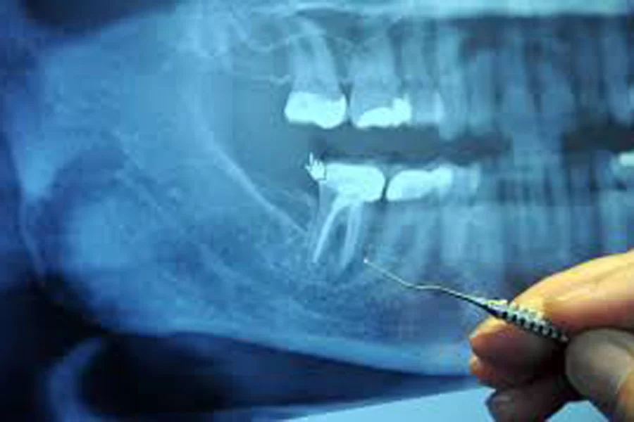 立川の歯医者、まろ歯科クリニックの親知らずの抜歯